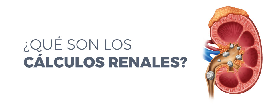 Cálculos renales